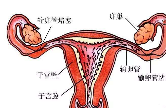 41岁输卵管不通能够 立即做试管婴儿吗？