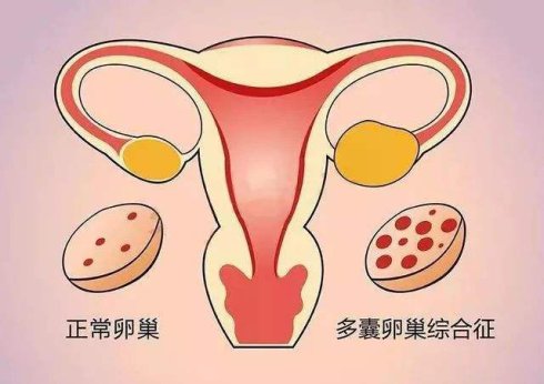 试管婴儿孕产期普遍母胎疾病预防方式 