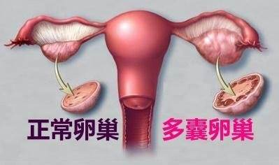 多囊患者做试管婴儿取得成功概率大吗